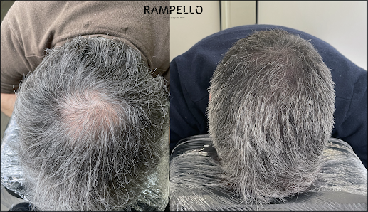 Immagine RAMPELLO SMP | Tricopigmentazione Chieri (Torino) 1