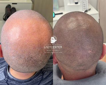 Immagine LADY CENTER | Tricopigmentazione & Dermopigmentazione 2