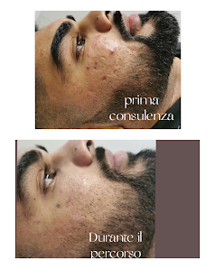 Immagine Anna Estetista Trucco Semipermanente microblading estetica specialistica Microneedling cicatrici trattamento acne unghie gel 1