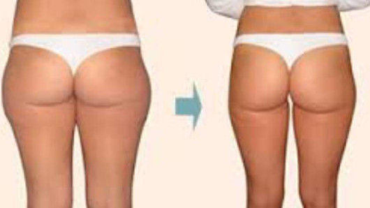 Immagine EVA IN FORMA & BENESSERE Centro di dimagrimento - rimodellamento della figura specializzato Contro la Cellulite Fibrosa 1