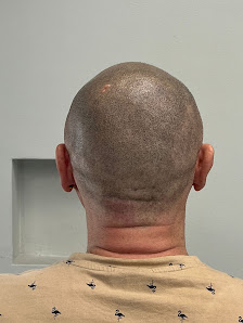 Immagine Emiliano Rossi Micropigmentazione tricologica | Soluzione per calvizie e alopecia 2
