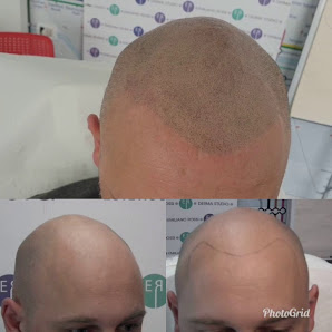 Immagine Emiliano Rossi Micropigmentazione tricologica | Soluzione per calvizie e alopecia 3