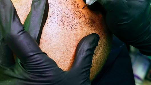 Immagine Tricopigmentazione Tea 1