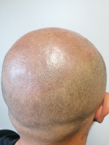 Immagine Tricopigmentazione Tea 2